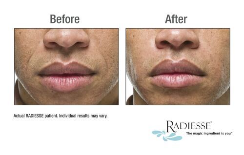 radiesse-severe